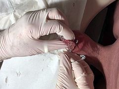 Foreskin closure